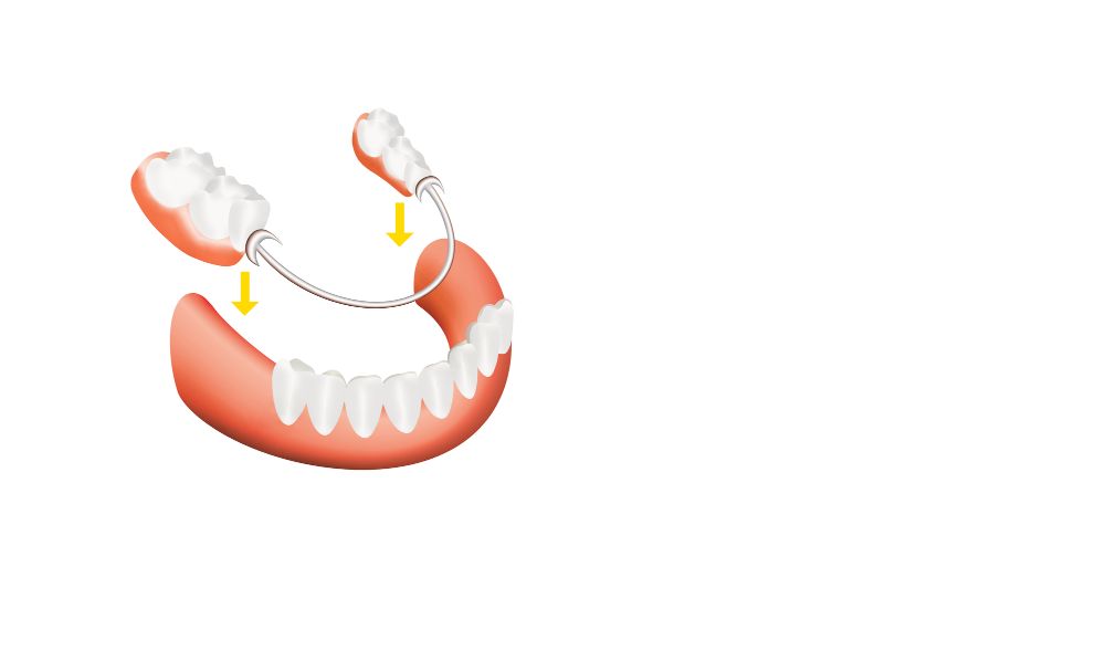 Are Flexible Partial Dentures Right For You? Pros And Cons