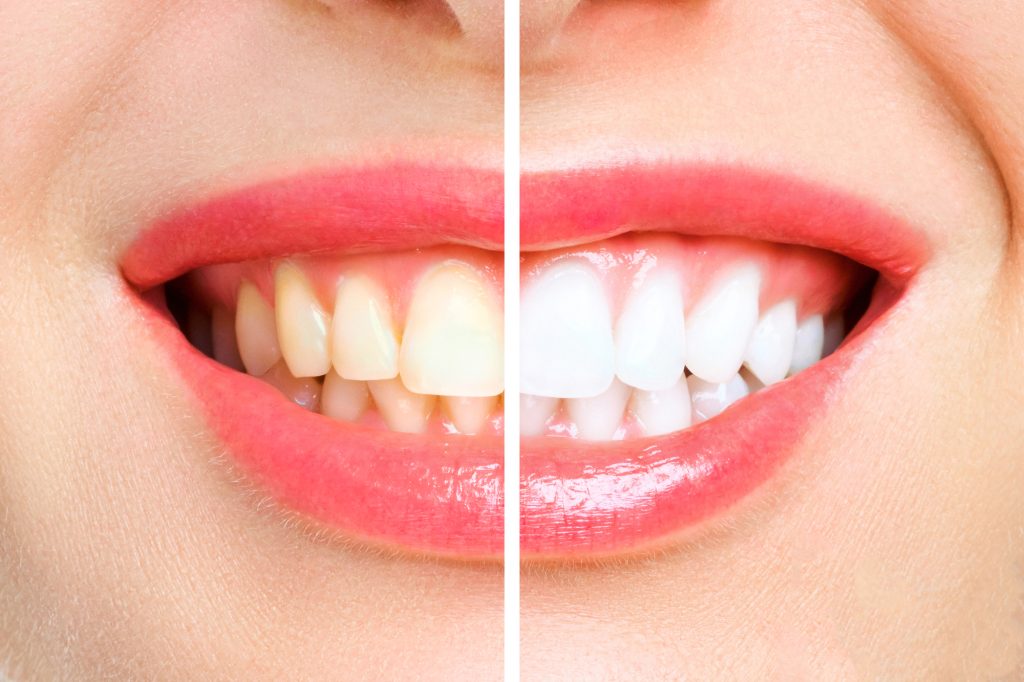 sensitive teeth whitening