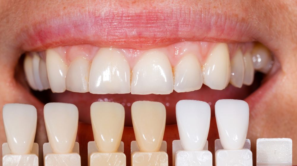 Types of Veneers: A Breakdown Of Cosmetic Dentistry Options