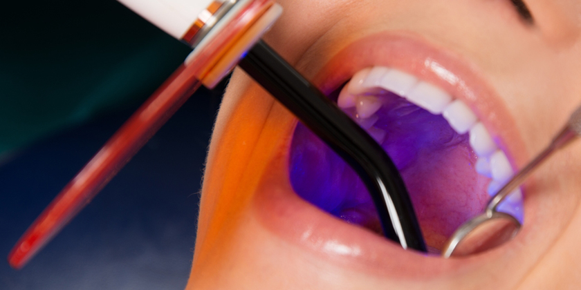 Determining Your Suitability for Dental Bonding