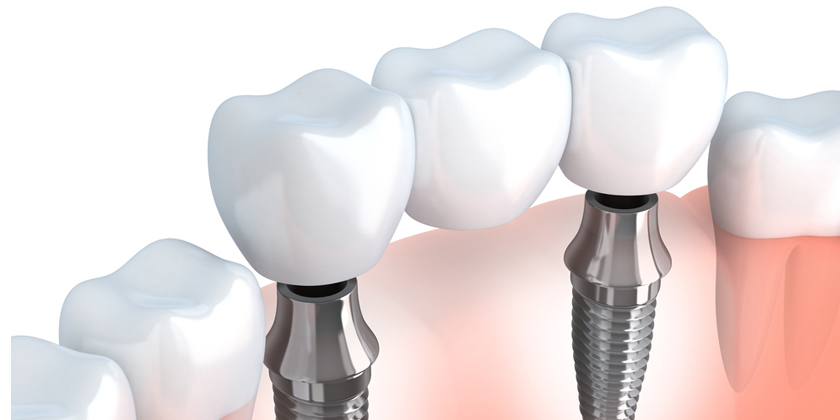 Did You Know That There’s More Than One Type Of Dental Implant?