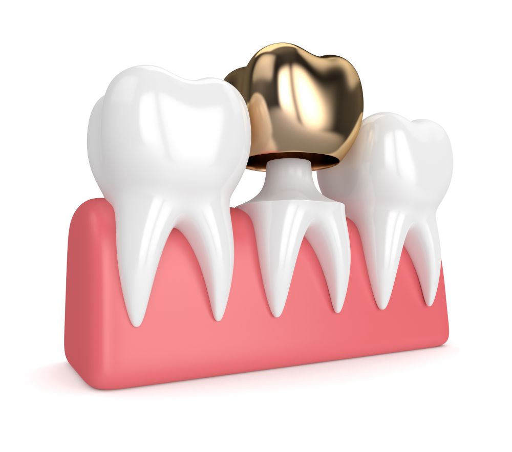 Different Types Of Dental Crowns For Every Need