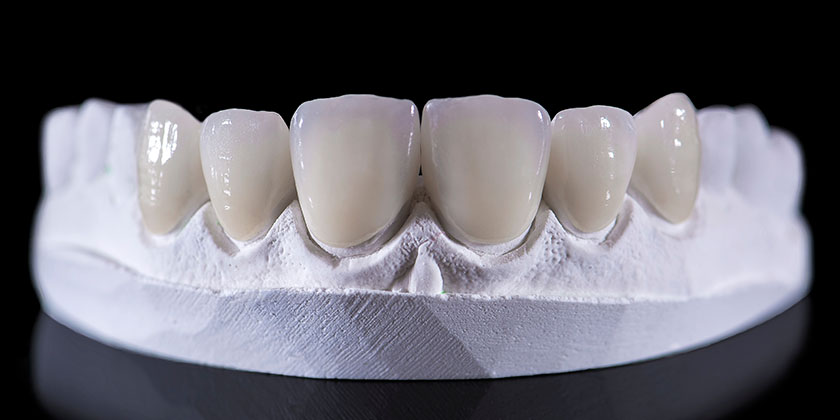 Do Porcelain Veneers Stain? 5 Facts To Know