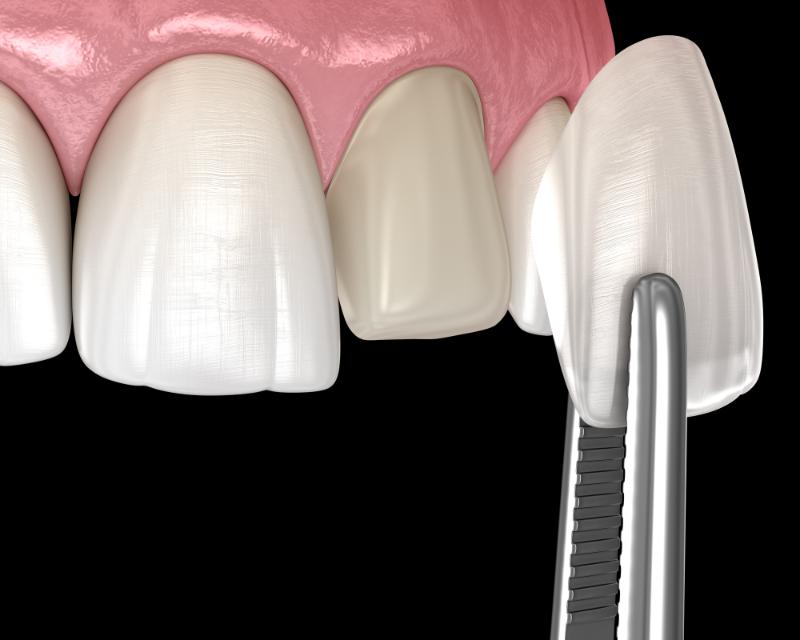 Do Veneers Hurt Or Is It Just A Dental Myth?