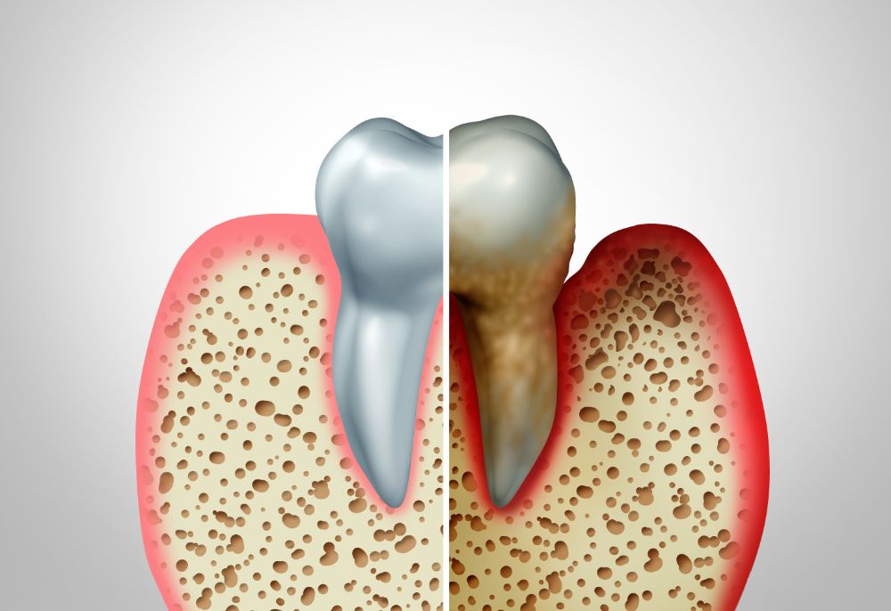 Do You Have Gum Disease?