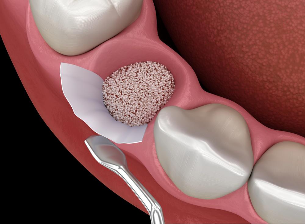 bone graft for implants
