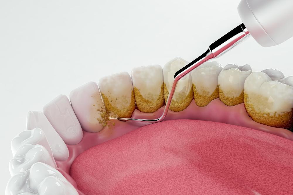 Do You Need Periodontal Maintenance Forever? What Patients Should Know