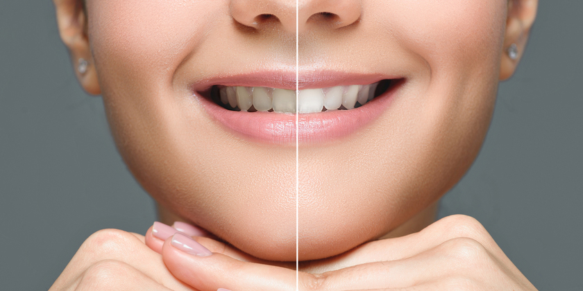 Does Age Matter When It Comes To Teeth Whitening?