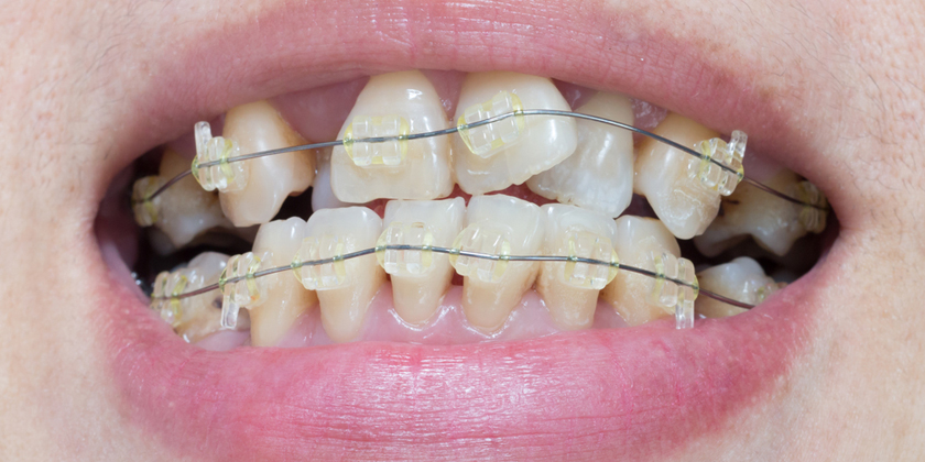 Does Crooked Teeth Make You Unsuitable For Porcelain Veneers?