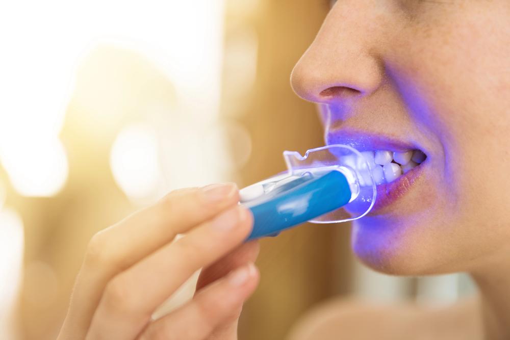 Don’t Attempt DIY Teeth Whitening – It’s Not Worth It!