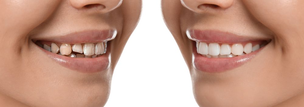 Don’t Make These Mistakes When Getting Dental Smile Makeover!