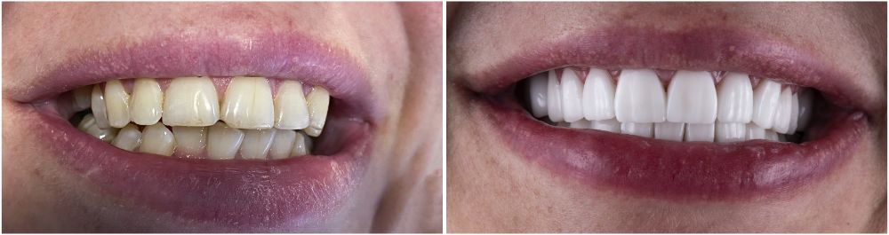 Don’t Misunderstand Porcelain Veneers!