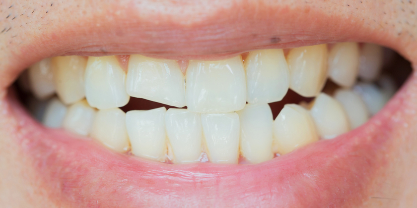 Effective Treatment For A Chipped Tooth