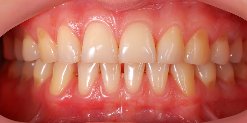 Everything You Need To Know About Gum Lifts