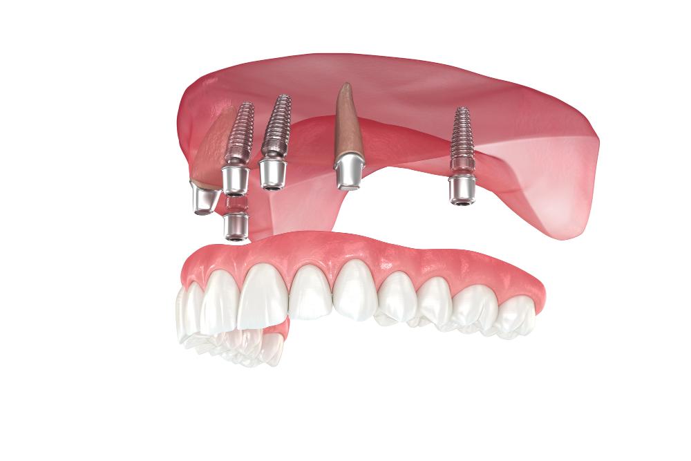 Facts To Know About Dental Implants For Your Upper Jaw