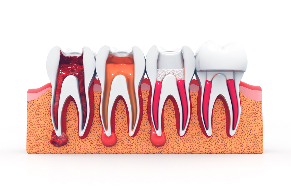 Failed Root Canal Procedures: Don’t Ignore These Warning Signs