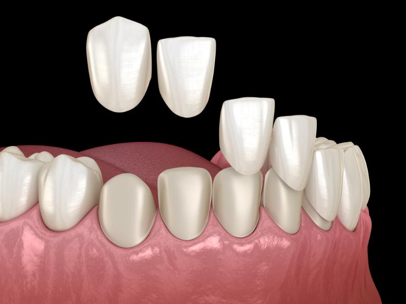 Full Mouth Veneer Vs. Partial: What’s Best For You?