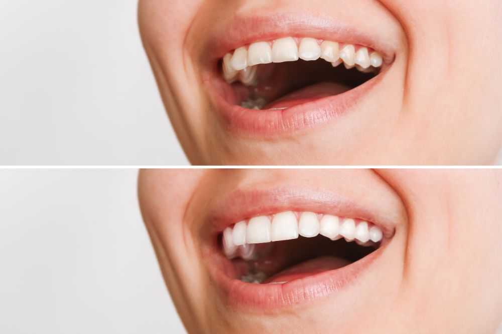 Getting Porcelain Veneers In New York City: 7 Questions To Ask