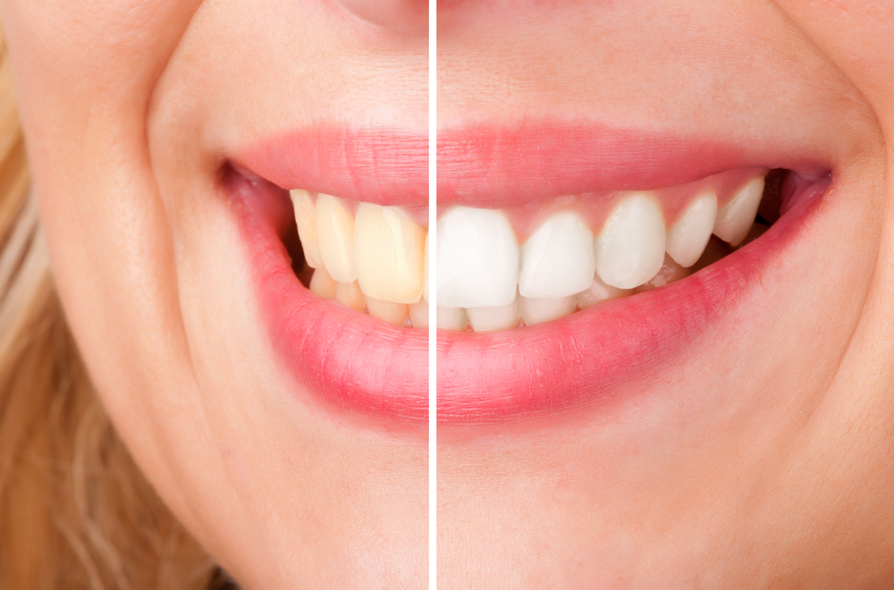Here’s What To Consider When Choosing The Best Teeth Whitening Dentist In NYC