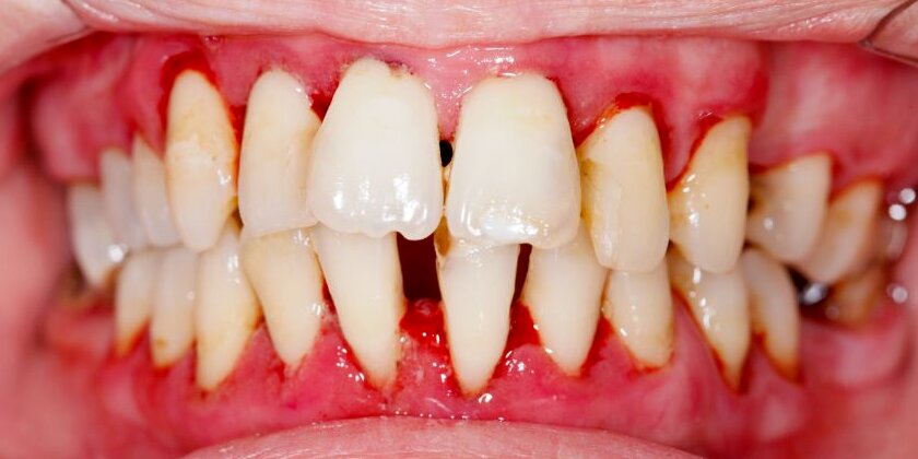 How Are Gum Disease And Your Overall Health Connected?