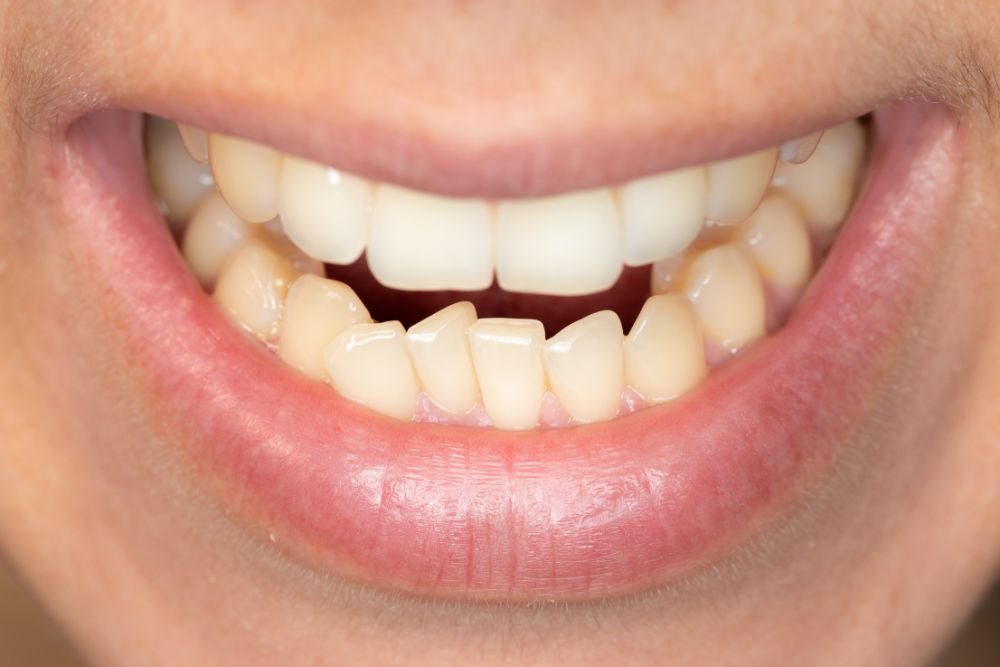 How Can Cosmetic Dentistry Help You With Your Underbite?