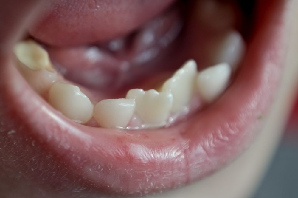 How Can Invisalign Help With Crowding Teeth?