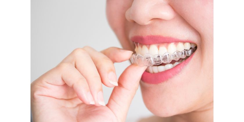 How Comfortable Are Invisalign Trays?