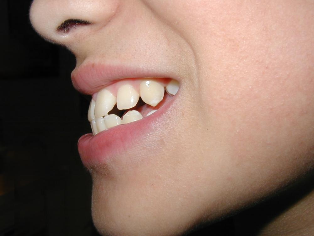 How Do Braces Fix An Overbite?