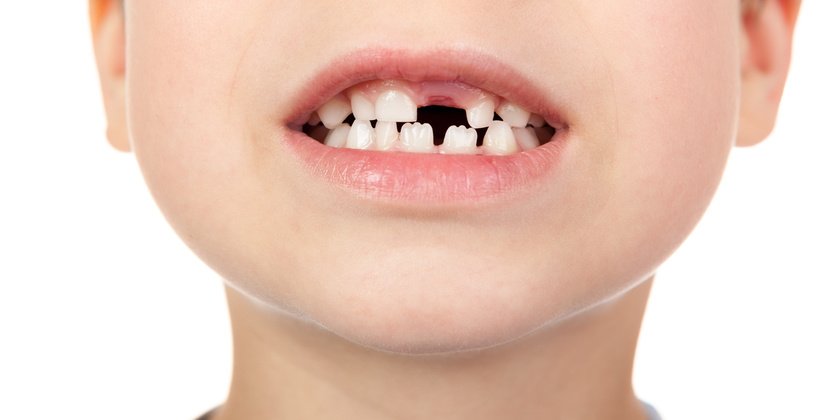 How Do Single Tooth Implants Help With Tooth Loss After A Sports Injury?