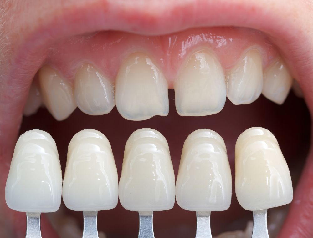 Smile Makeover