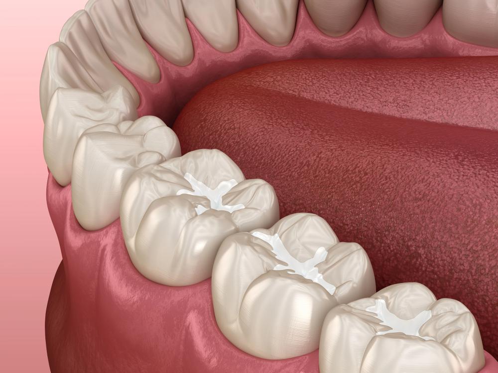 How Long Do Dental Sealants Last? A Simple Breakdown