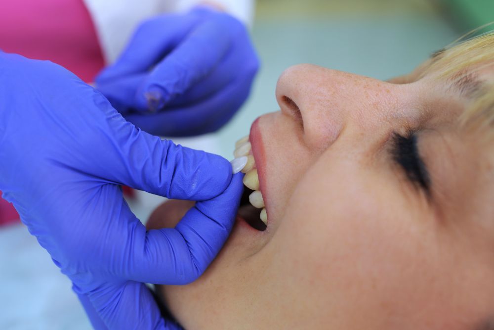 How Long Do Dental Veneers Last?