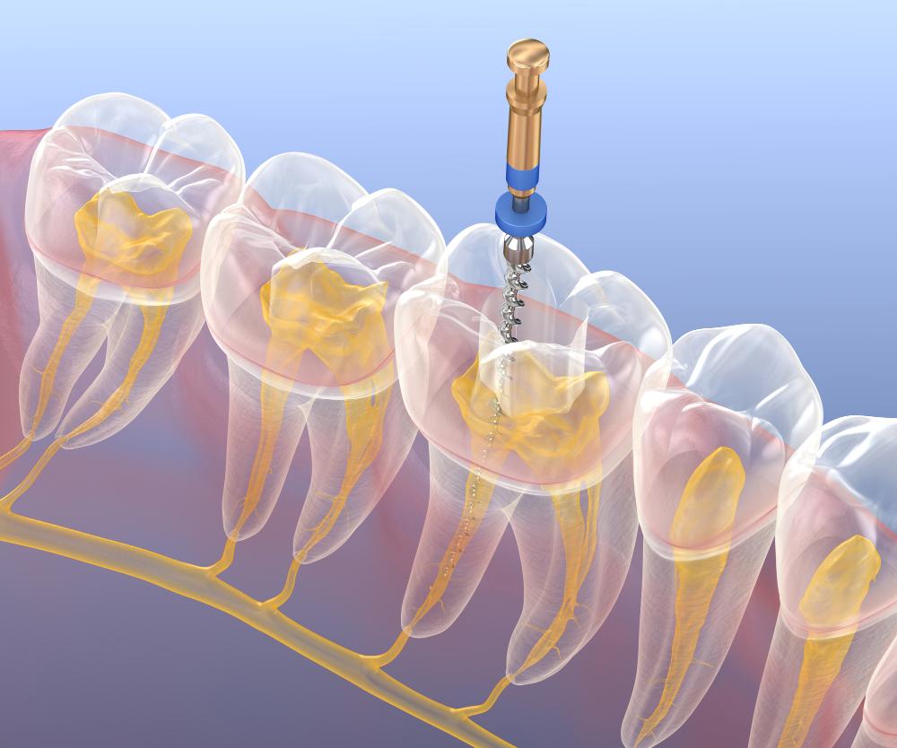 How Long Does A Root Canal Treatment Take?
