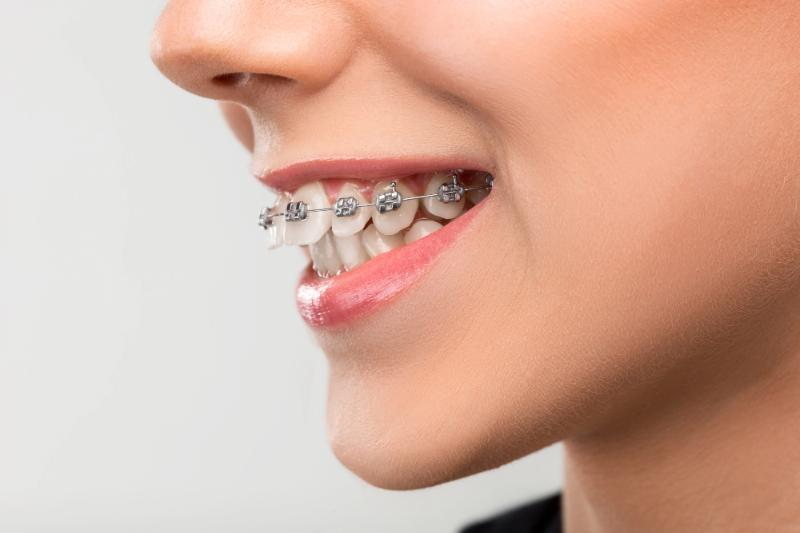 How Long Does It Take To Fix An Overbite?