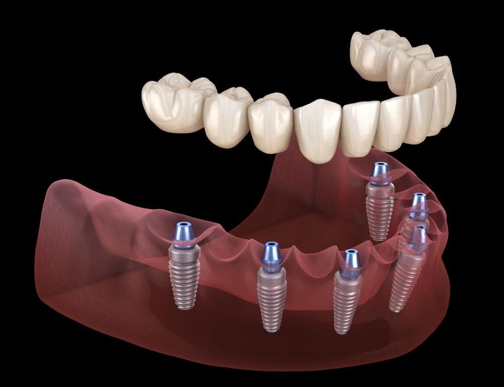 How Many Dental Implants Can You Have?