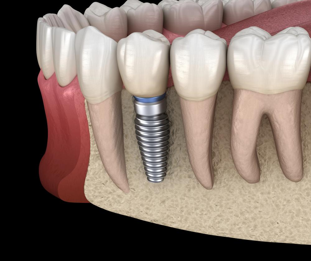 How Many Visits Are Needed For Dental Implants?