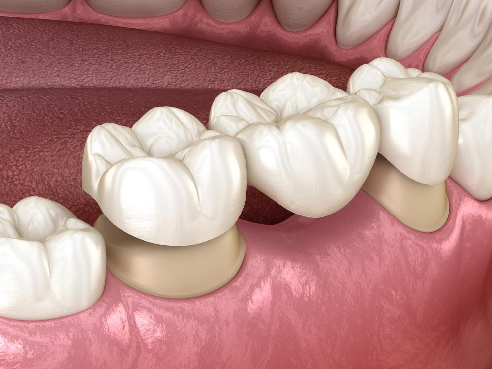 How Much Does A Dental Bridge Cost? Factors And Estimates