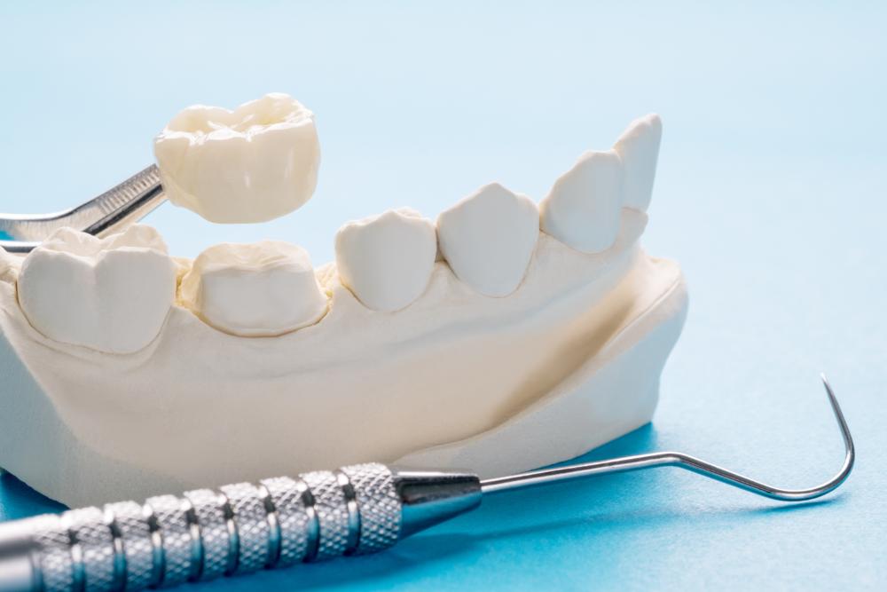 How Much Does A Dental Crown Treatment Cost?