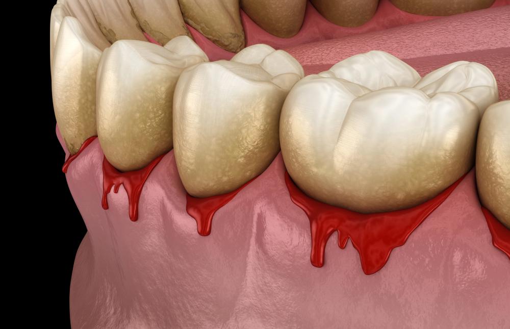 How Much Does Gum Disease Treatment Cost In NYC?