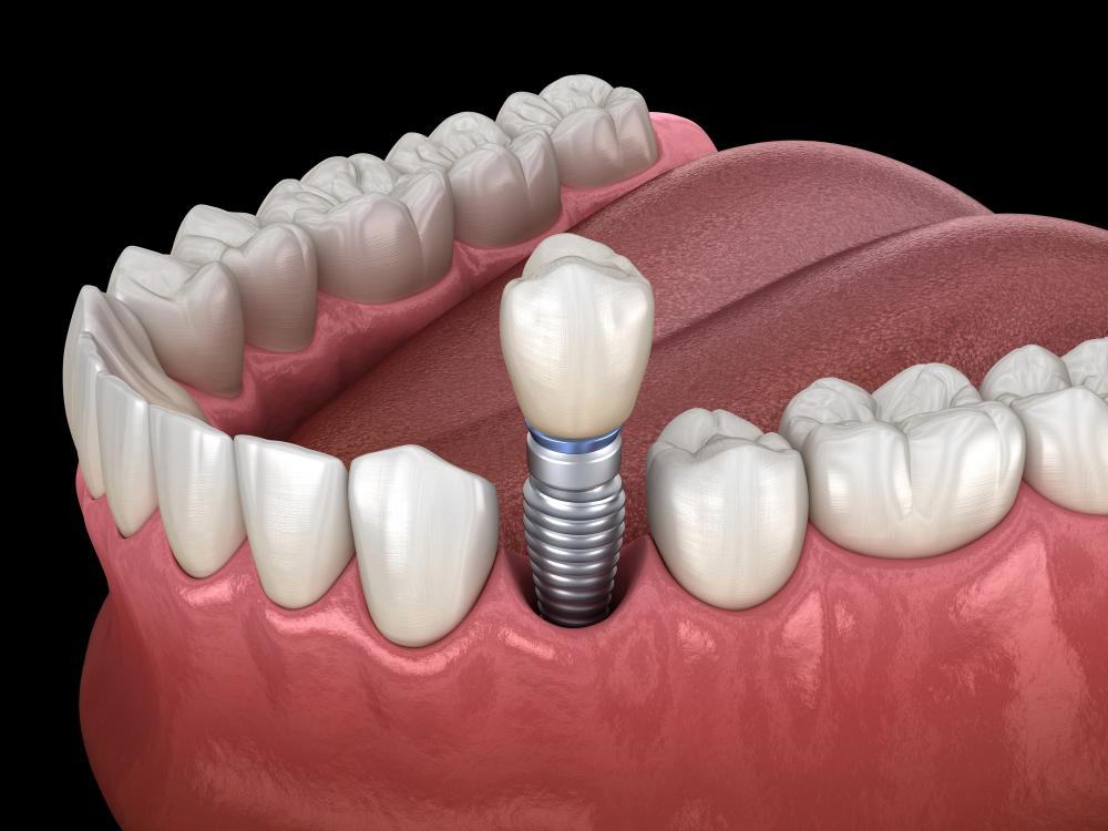 How Much Does One Dental Implant Cost In NYC?