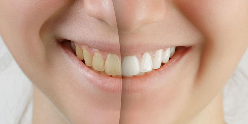 How Often Should You Go To A Dentist For Teeth Whitening?