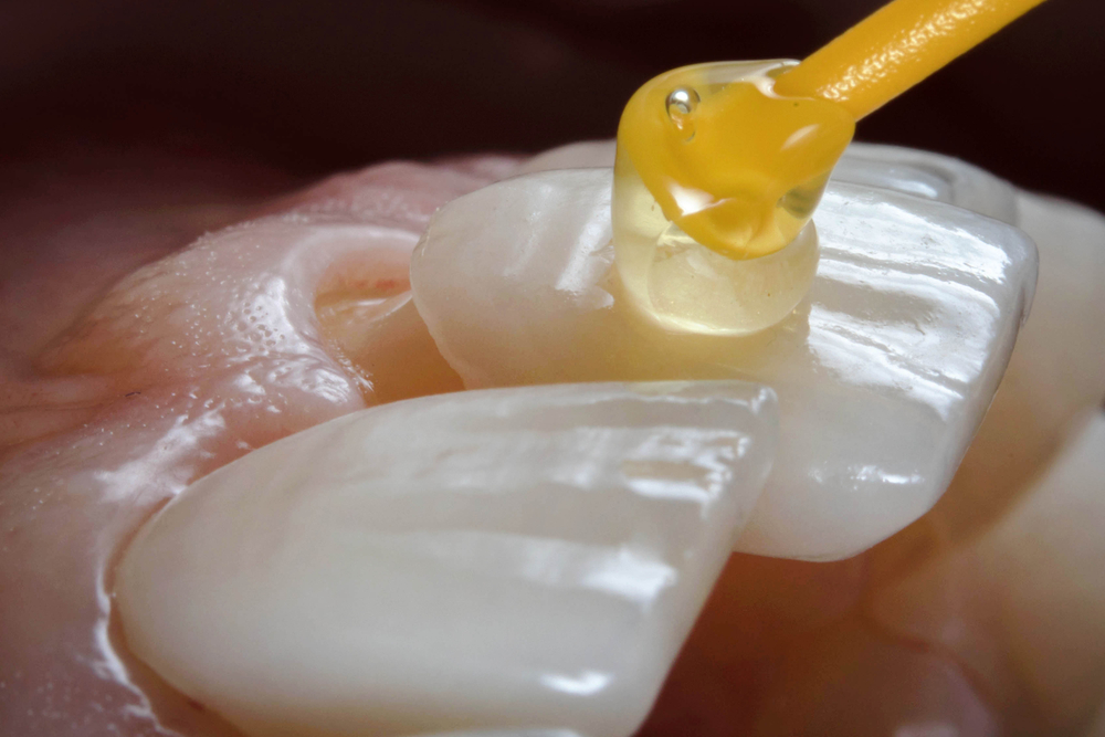 How Often Should You Replace Veneers?