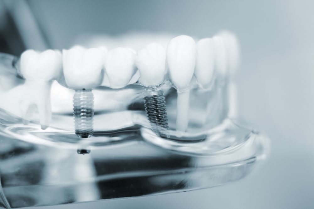 How Safe Are Dental Implants?