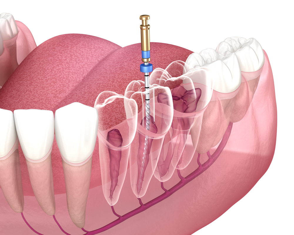 How To Avoid Root Canal: 4 Tips For Dental Health