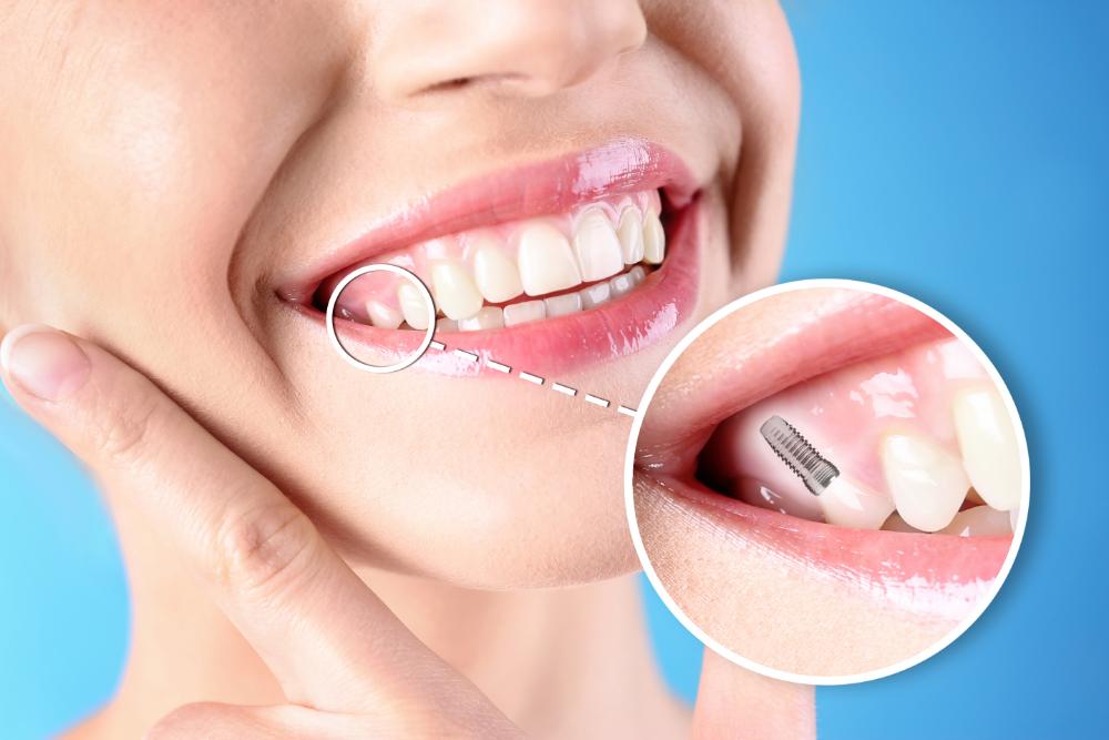 How To Clean All-On-4 Dental Implants