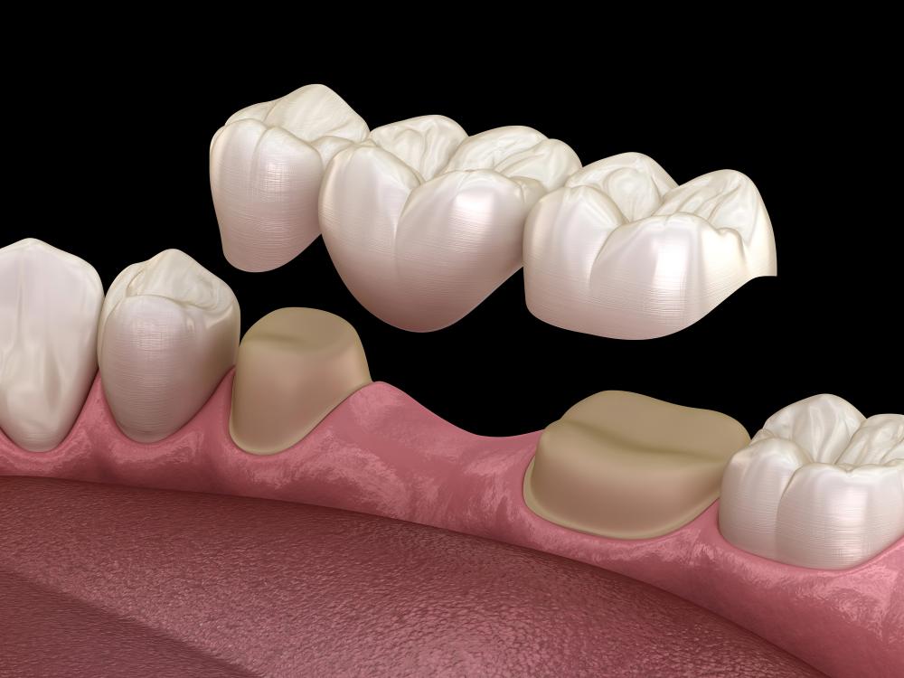 How To Find The Right Dentist For A Dental Bridge In NYC