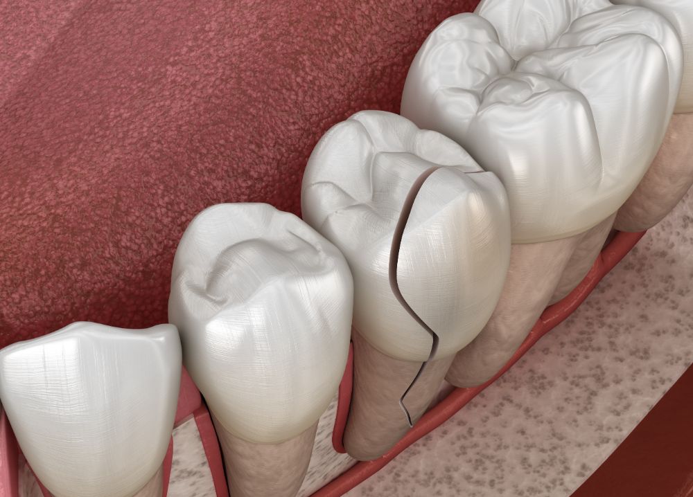 How To Fix A Chipped Tooth