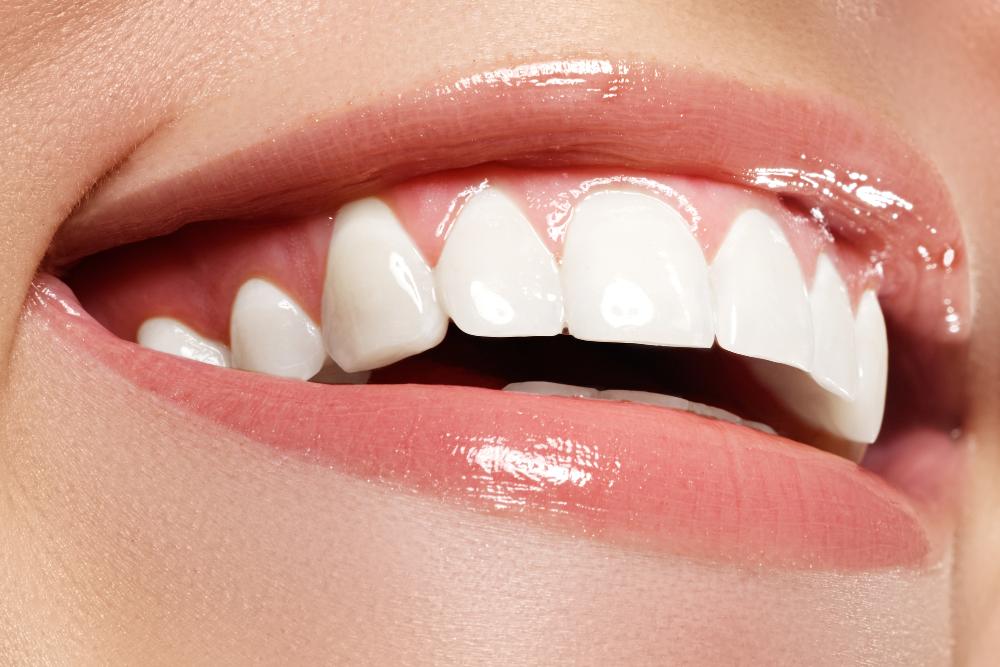 How To Get A Smile Makeover In A Same-Day Appointment In NYC