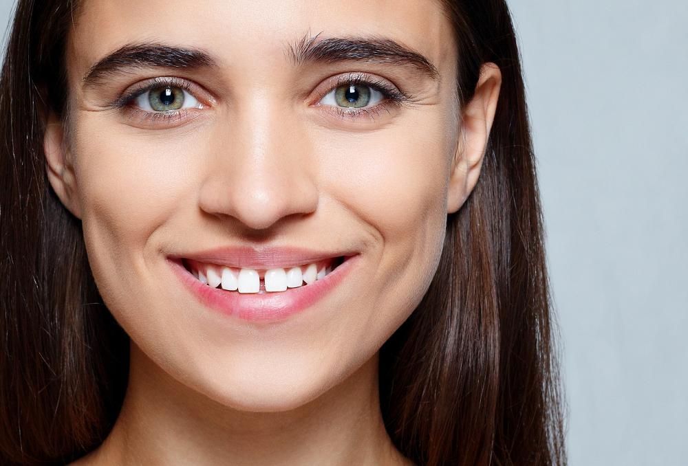 How To Get Rid Of A Teeth Gap Safely