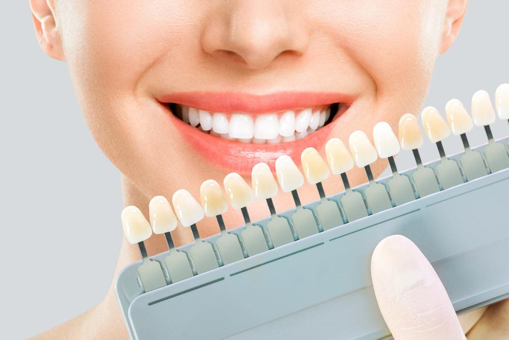 shades of veneers